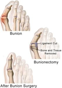 Bilateral Bunionectomy · 2018 Top Foot Doctor, Podiatrist in NYC