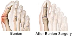 Bunion Surgery Manhattan | NYC Best Bunion Removal Surgeon